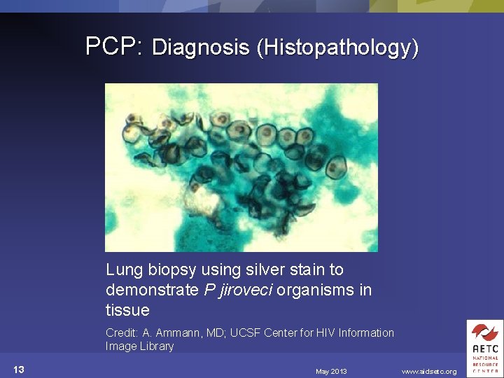 PCP: Diagnosis (Histopathology) Lung biopsy using silver stain to demonstrate P jiroveci organisms in