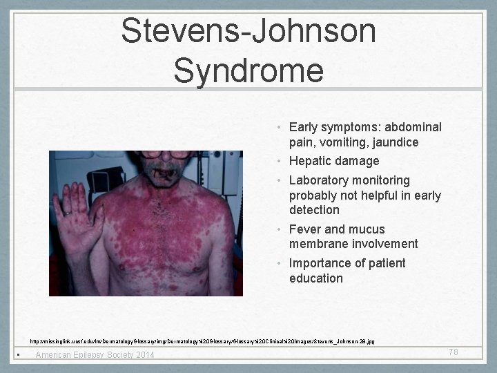 Stevens-Johnson Syndrome • Early symptoms: abdominal pain, vomiting, jaundice • Hepatic damage • Laboratory