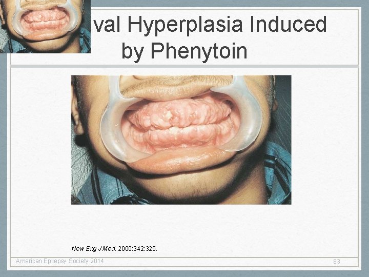 Gingival Hyperplasia Induced by Phenytoin New Eng J Med. 2000: 342: 325. American Epilepsy Gingival Hyperplasia Induced by Phenytoin New Eng J Med. 2000: 342: 325. American Epilepsy