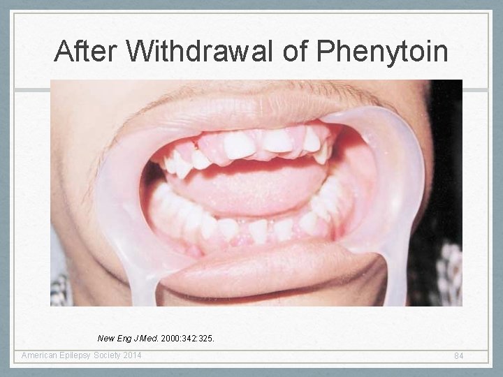 After Withdrawal of Phenytoin New Eng J Med. 2000: 342: 325. American Epilepsy Society After Withdrawal of Phenytoin New Eng J Med. 2000: 342: 325. American Epilepsy Society