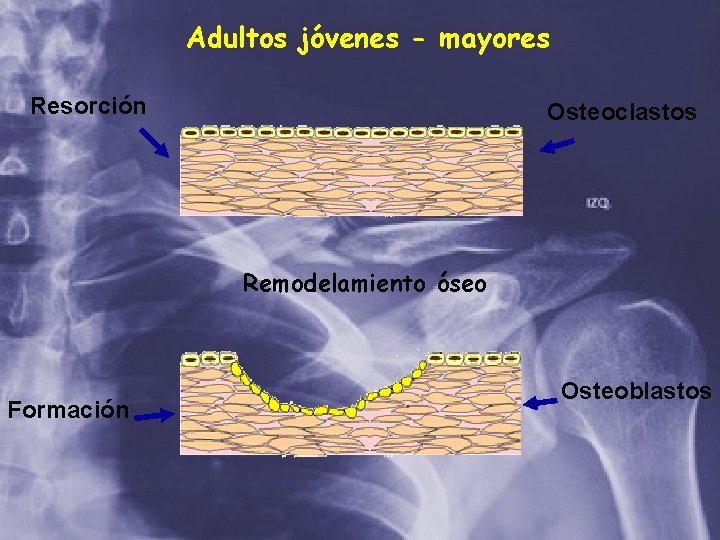 Adultos jóvenes - mayores Resorción Osteoclastos Remodelamiento óseo Formación Osteoblastos 