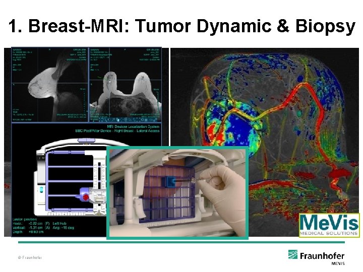 1. Breast-MRI: Tumor Dynamic & Biopsy © Fraunhofer 1. Breast-MRI: Tumor Dynamic & Biopsy © Fraunhofer