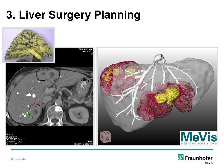 3. Liver Surgery Planning © Fraunhofer 3. Liver Surgery Planning © Fraunhofer