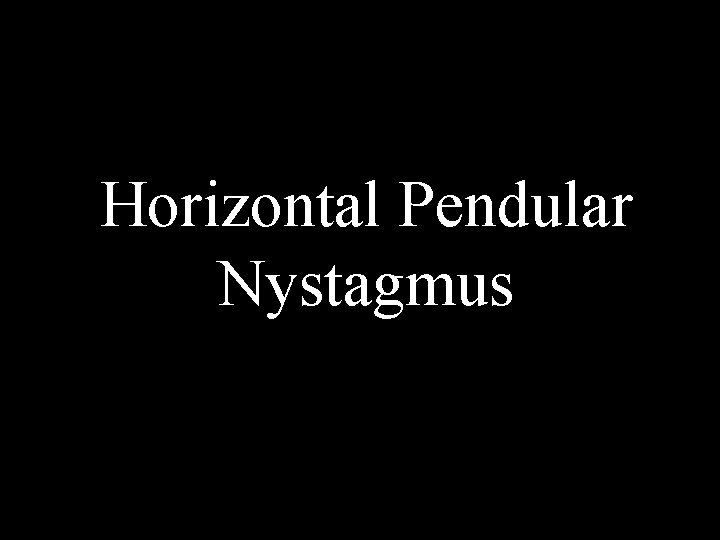 Horizontal Pendular Nystagmus Horizontal Pendular Nystagmus