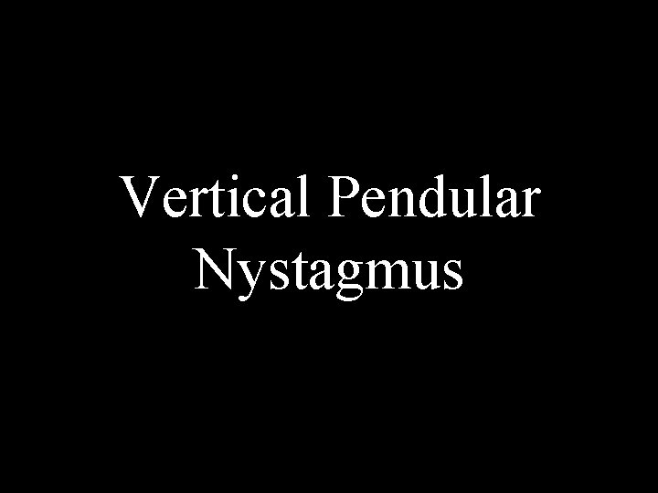 Vertical Pendular Nystagmus Vertical Pendular Nystagmus