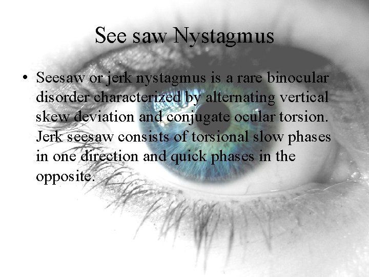 See saw Nystagmus • Seesaw or jerk nystagmus is a rare binocular disorder characterized See saw Nystagmus • Seesaw or jerk nystagmus is a rare binocular disorder characterized