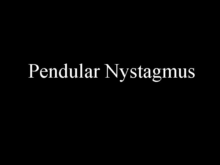 Pendular Nystagmus Pendular Nystagmus