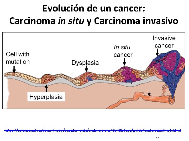 Evolución de un cancer: Carcinoma in situ y Carcinoma invasivo https: //science. education. nih.