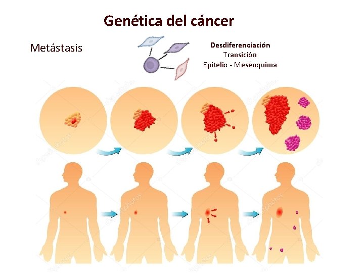 Genética del cáncer Metástasis Desdiferenciación Transición Epitelio - Mesénquima 