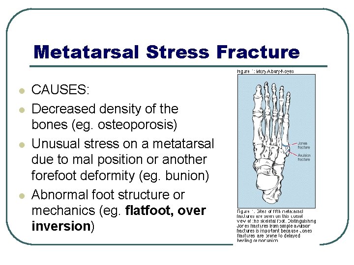 Metatarsal Stress Fracture l l CAUSES: Decreased density of the bones (eg. osteoporosis) Unusual