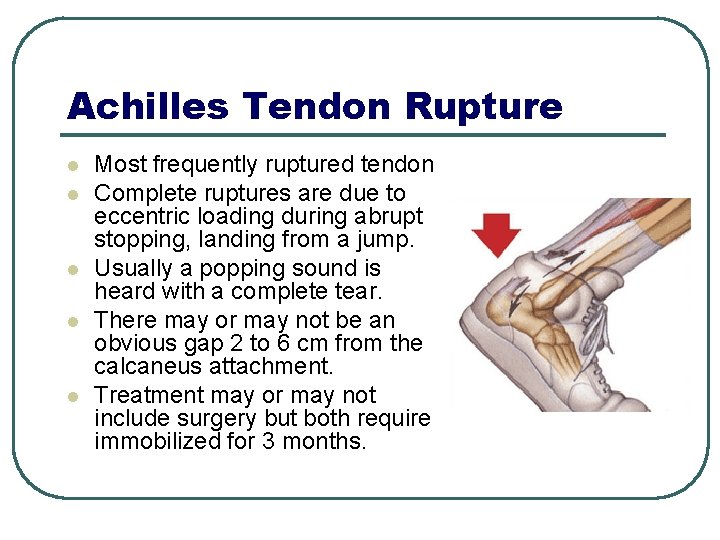 Achilles Tendon Rupture l l l Most frequently ruptured tendon Complete ruptures are due