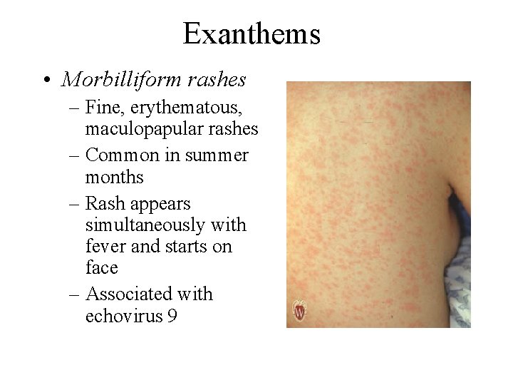 Exanthems • Morbilliform rashes – Fine, erythematous, maculopapular rashes – Common in summer months