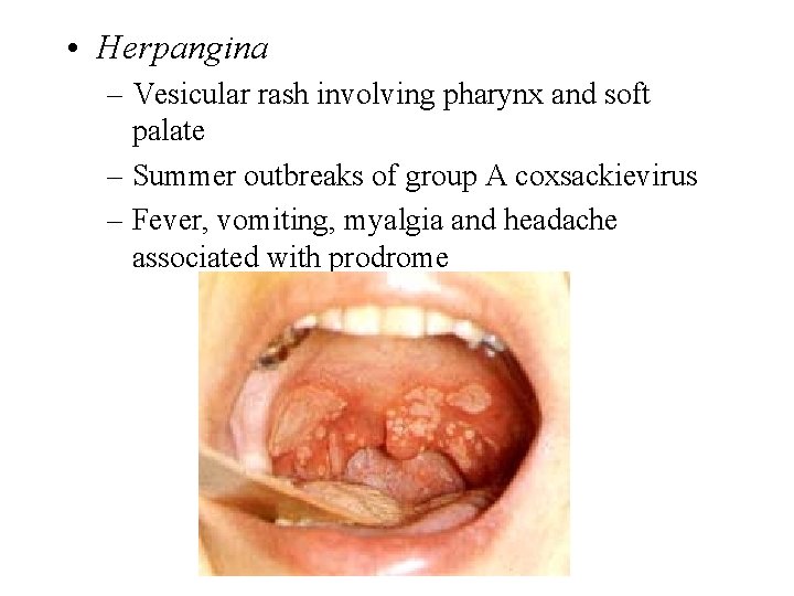  • Herpangina – Vesicular rash involving pharynx and soft palate – Summer outbreaks