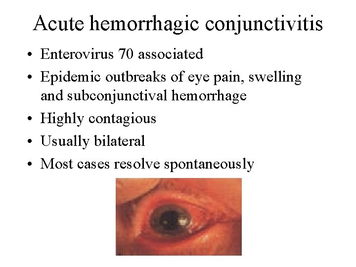 Acute hemorrhagic conjunctivitis • Enterovirus 70 associated • Epidemic outbreaks of eye pain, swelling
