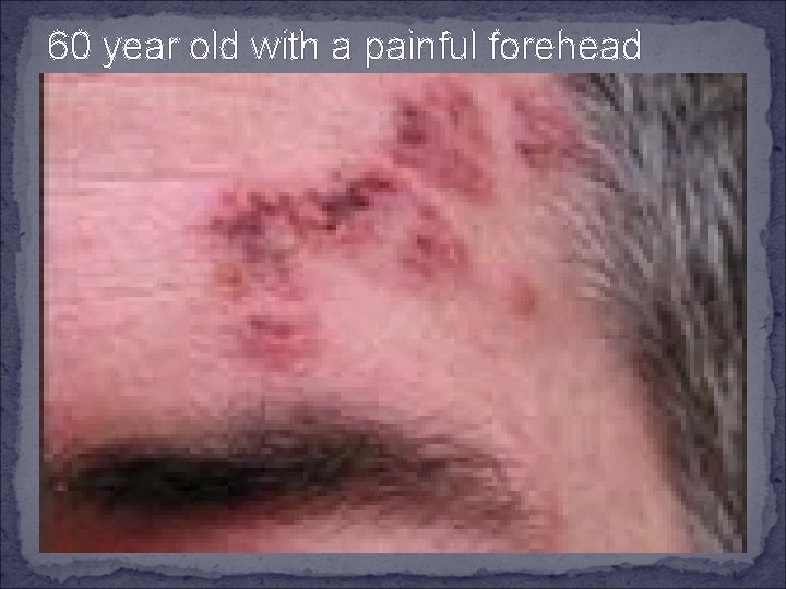 60 year old with a painful forehead 