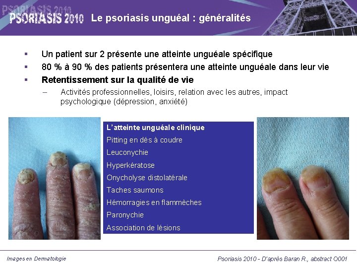 Le psoriasis unguéal : généralités Un patient sur 2 présente une atteinte unguéale spécifique