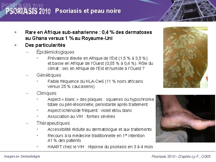 Psoriasis et peau noire Rare en Afrique sub-saharienne : 0, 4 % des dermatoses