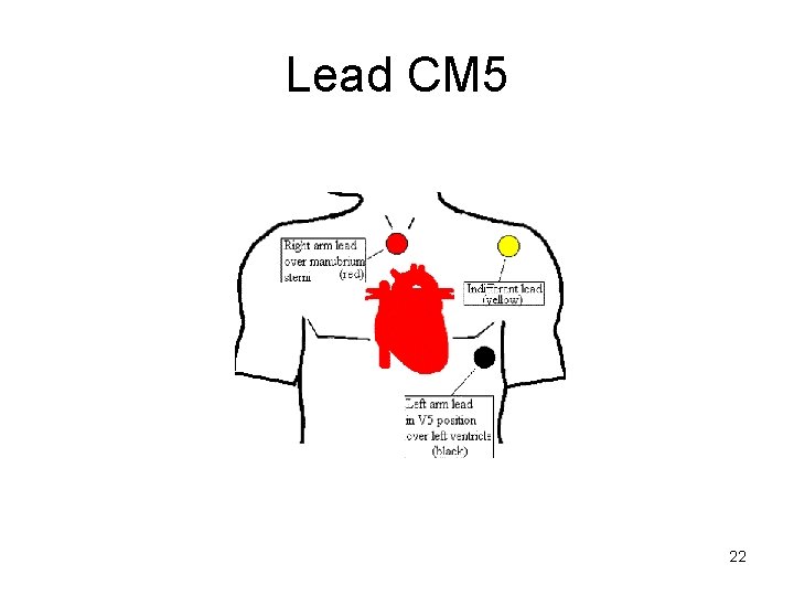 Lead CM 5 22 