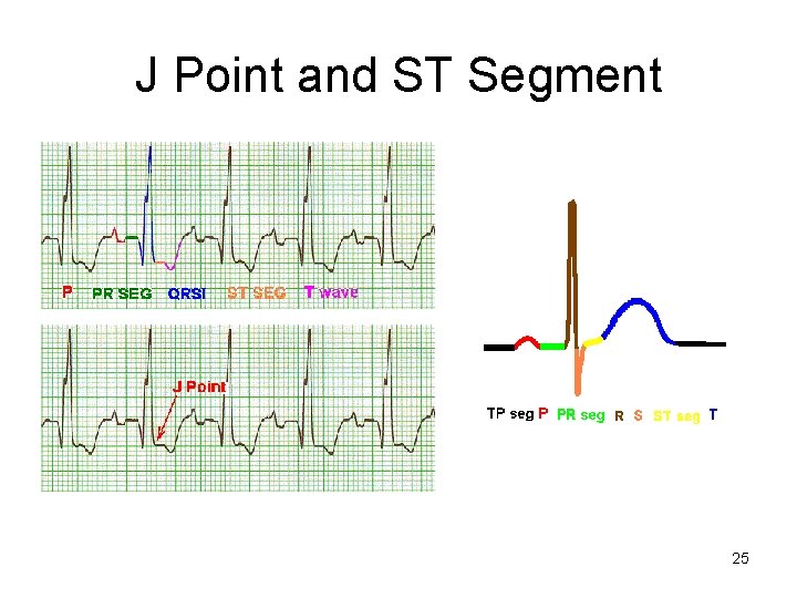 J Point and ST Segment 25 