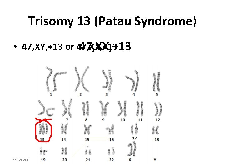Trisomy 13 (Patau Syndrome) • 47, XY, +13 or 47, XX, +13 11: 32
