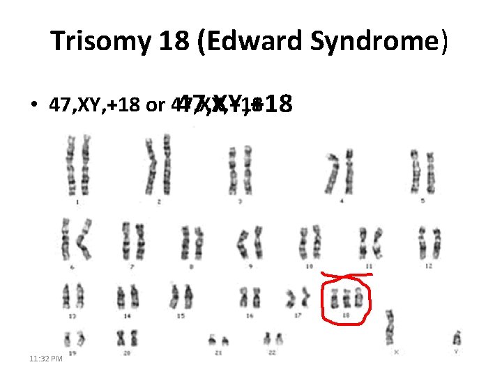 Trisomy 18 (Edward Syndrome) • 47, XY, +18 or 47, XX, +18 47, XY,
