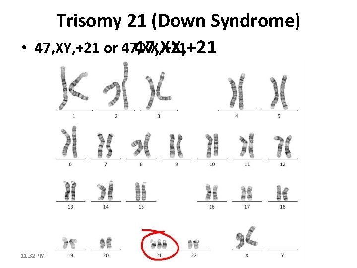 Trisomy 21 (Down Syndrome) • 47, XY, +21 or 47, XX, +21 11: 32