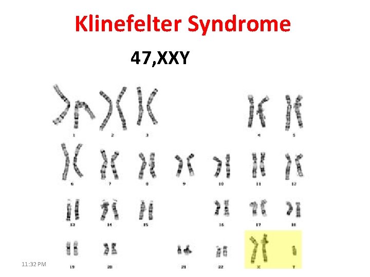 Klinefelter Syndrome 47, XXY 11: 32 PM 