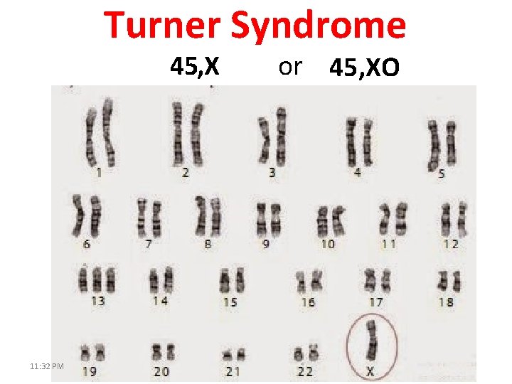 Turner Syndrome 45, X 11: 32 PM or 45, XO 
