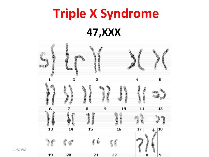 Triple X Syndrome 47, XXX 11: 32 PM 