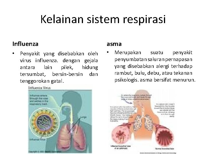 Kelainan sistem respirasi Influenza asma • Penyakit yang disebabkan oleh virus influenza. dengan gejala