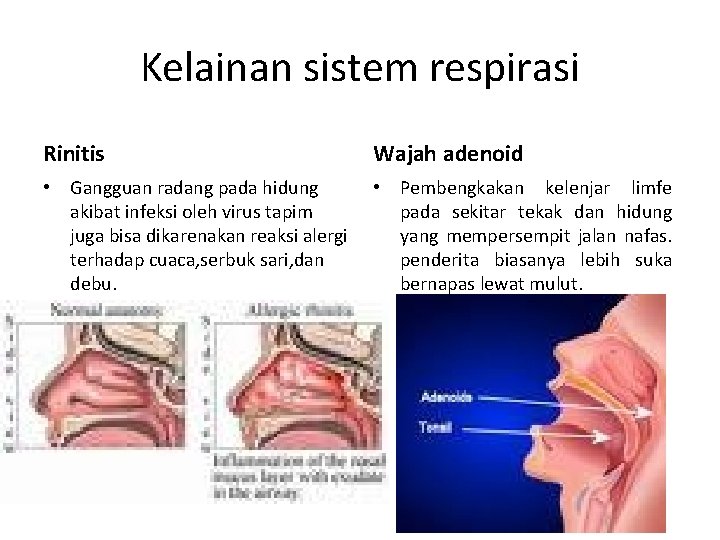 Kelainan sistem respirasi Rinitis Wajah adenoid • Gangguan radang pada hidung akibat infeksi oleh
