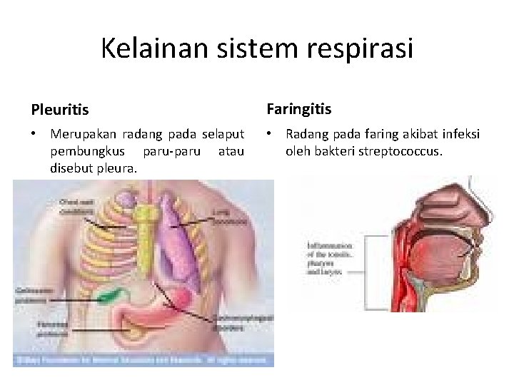 Kelainan sistem respirasi Pleuritis Faringitis • Merupakan radang pada selaput pembungkus paru-paru atau disebut