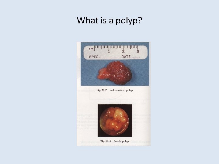 What is a polyp? 