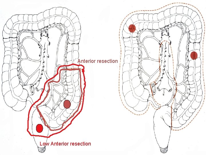 Anterior resection Subtotal Colectomy Low Anterior resection 
