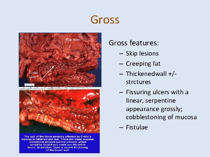 Gross features: – Skip lesions – Creeping fat – Thickenedwall +/strctures – Fissuring ulcers