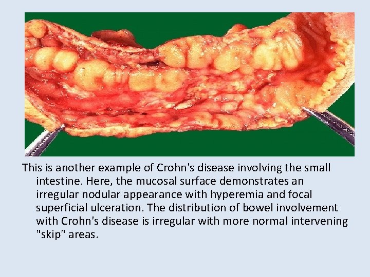 This is another example of Crohn's disease involving the small intestine. Here, the mucosal