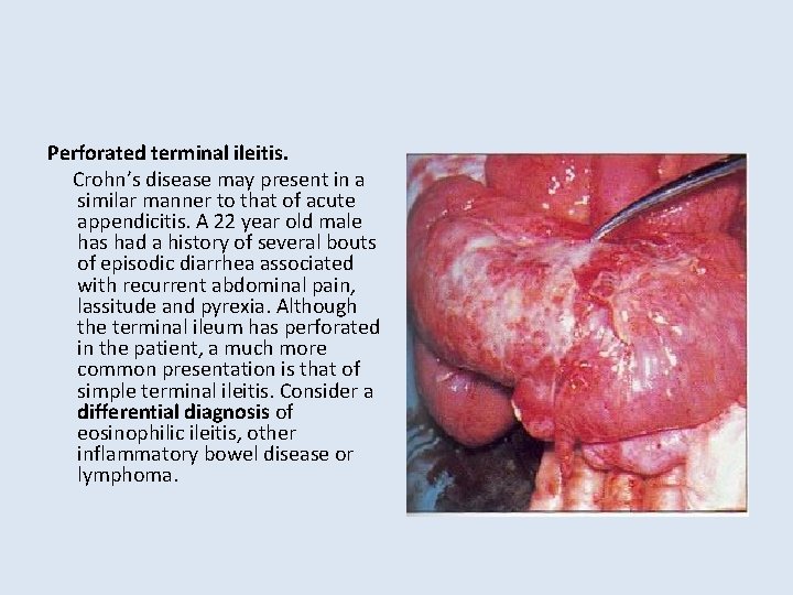 Perforated terminal ileitis. Crohn’s disease may present in a similar manner to that of