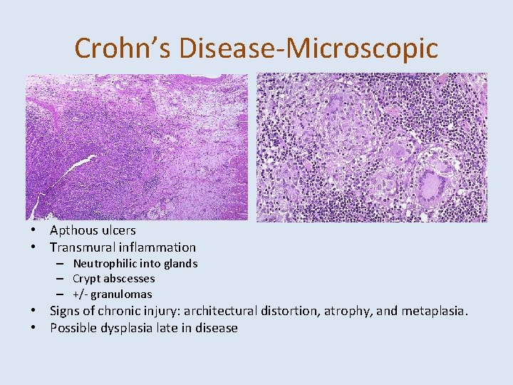 Crohn’s Disease-Microscopic • Apthous ulcers • Transmural inflammation – Neutrophilic into glands – Crypt