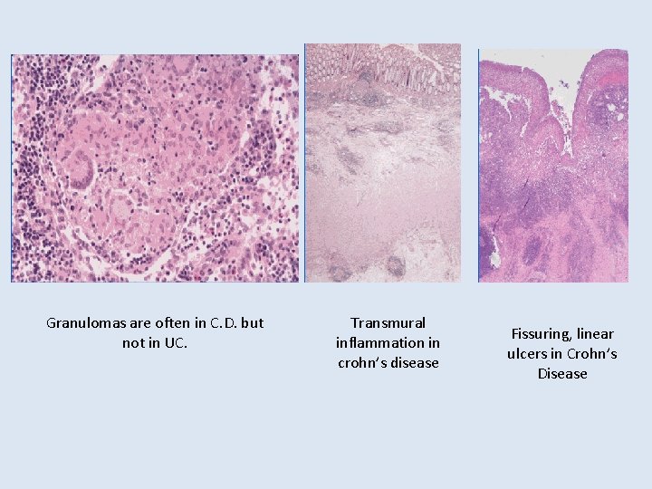 Granulomas are often in C. D. but not in UC. Transmural inflammation in crohn’s