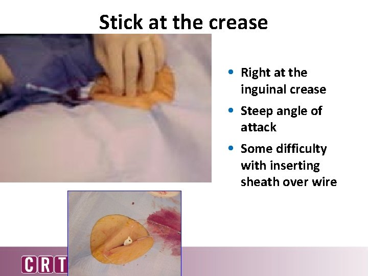 Stick at the crease • Right at the inguinal crease • Steep angle of