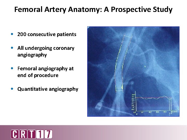 Femoral Artery Anatomy: A Prospective Study • 200 consecutive patients • All undergoing coronary