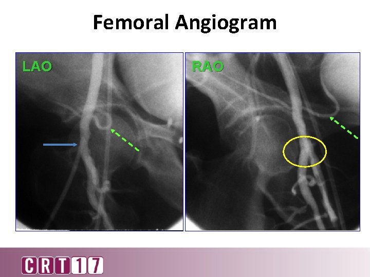 Femoral Angiogram LAO RAO 