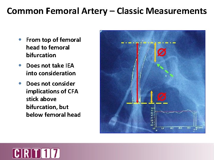 Common Femoral Artery – Classic Measurements • From top of femoral head to femoral