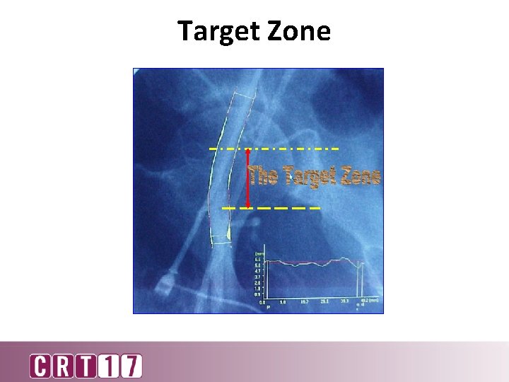 Target Zone 