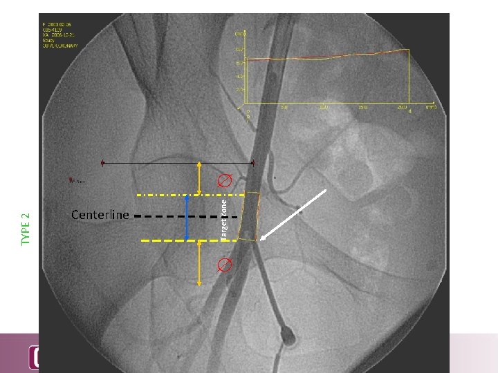 TYPE 2 Centerline Target Zone 