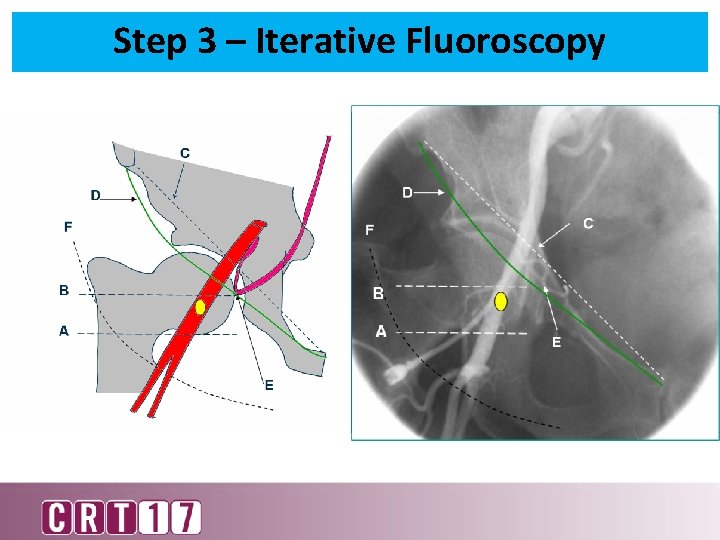 Step 3 – Iterative Fluoroscopy 