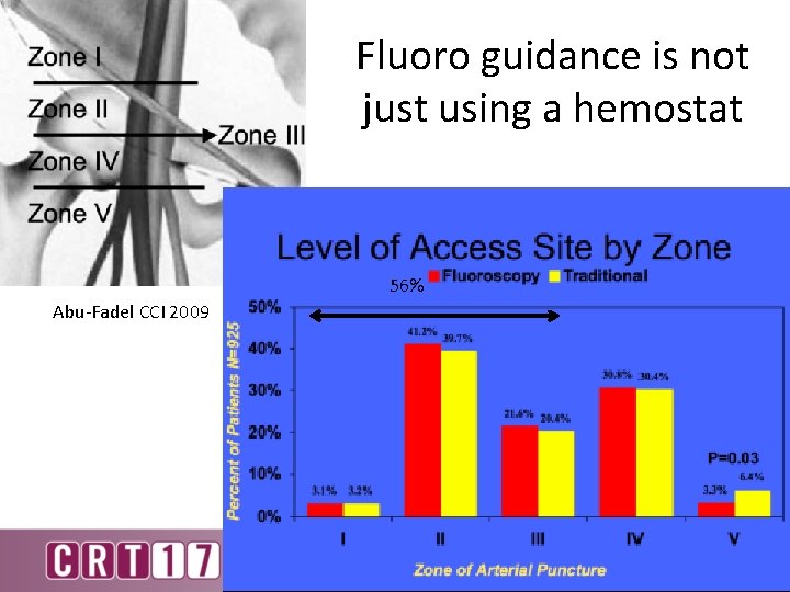 Fluoro guidance is not just using a hemostat 56% Abu-Fadel CCI 2009 