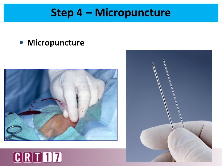 Step 4 – Micropuncture • Micropuncture 