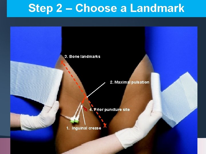 Step 2 – Choose a Landmark 3. Bone landmarks X 2. Maximal pulsation 4.