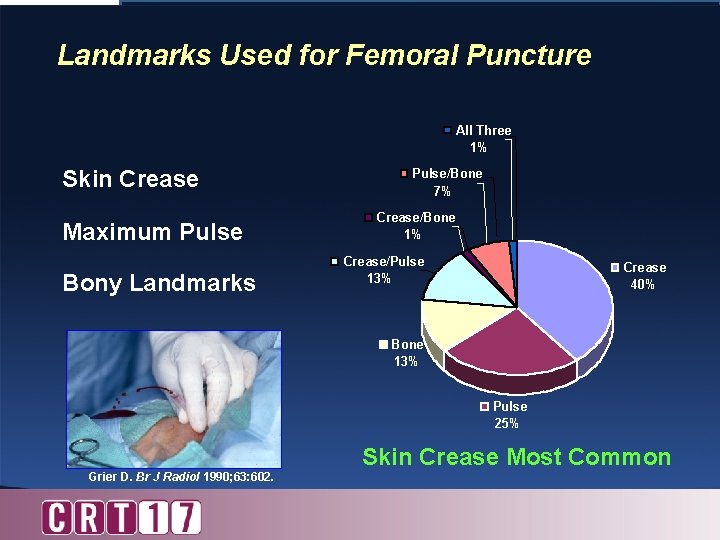 Landmarks Used for Femoral Puncture All Three 1% Skin Crease Maximum Pulse Bony Landmarks